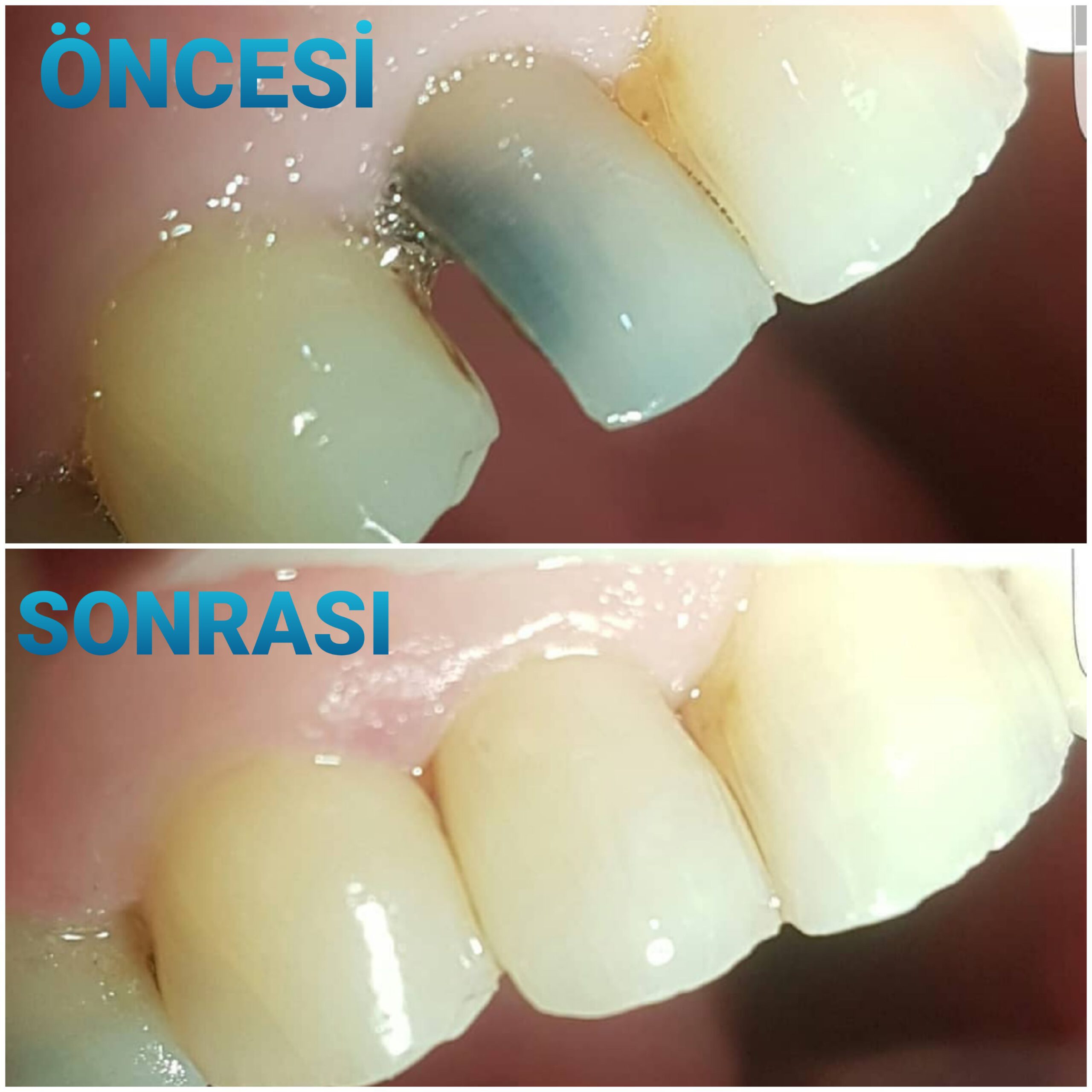 Denttaş Diş Kliniği'nde uygulanan estetik kompozit dolgu çalışması