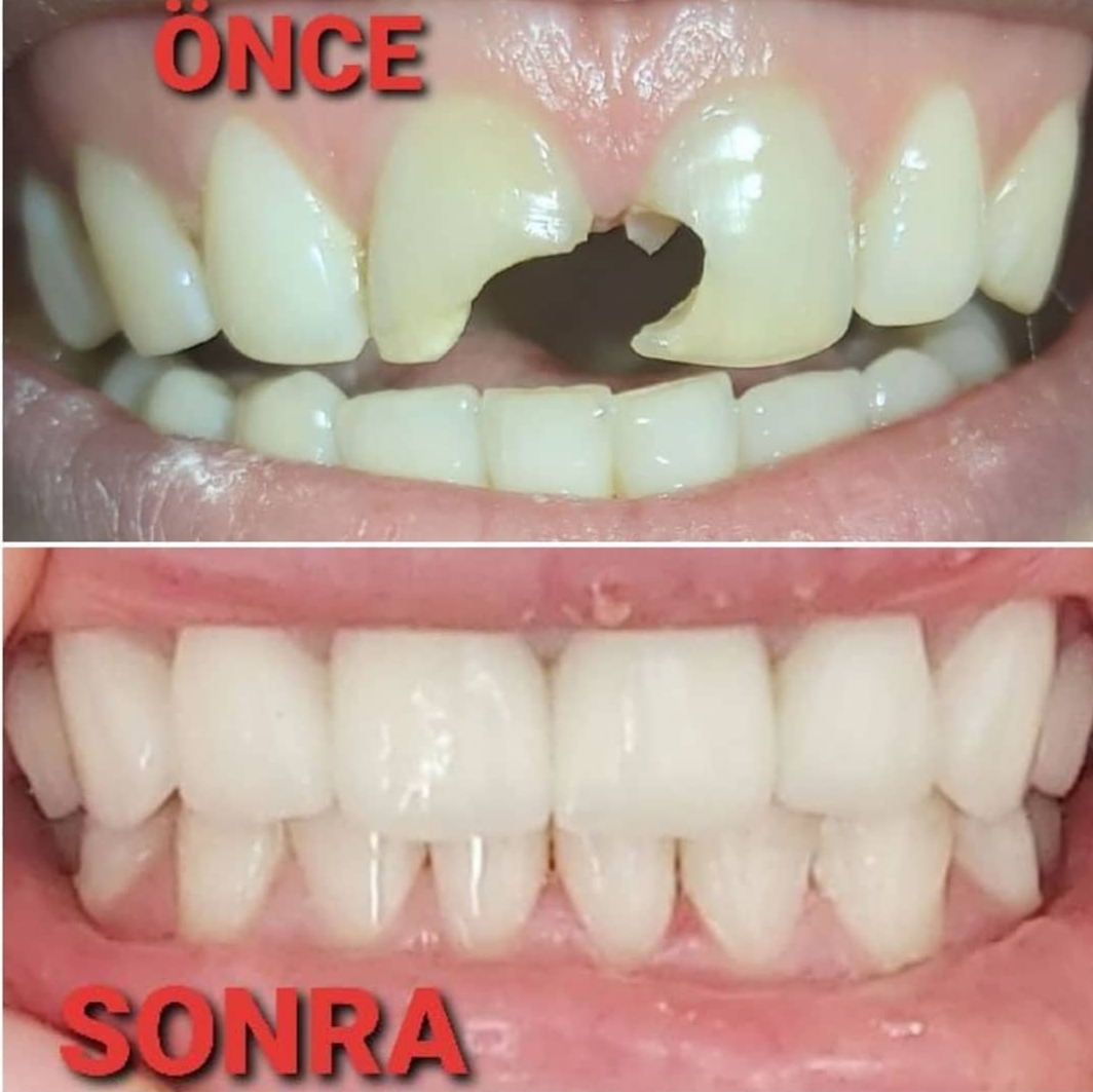 Kırık ön dişlerin full zirkonyum kaplama ile yenilenmesi — önce ve sonra