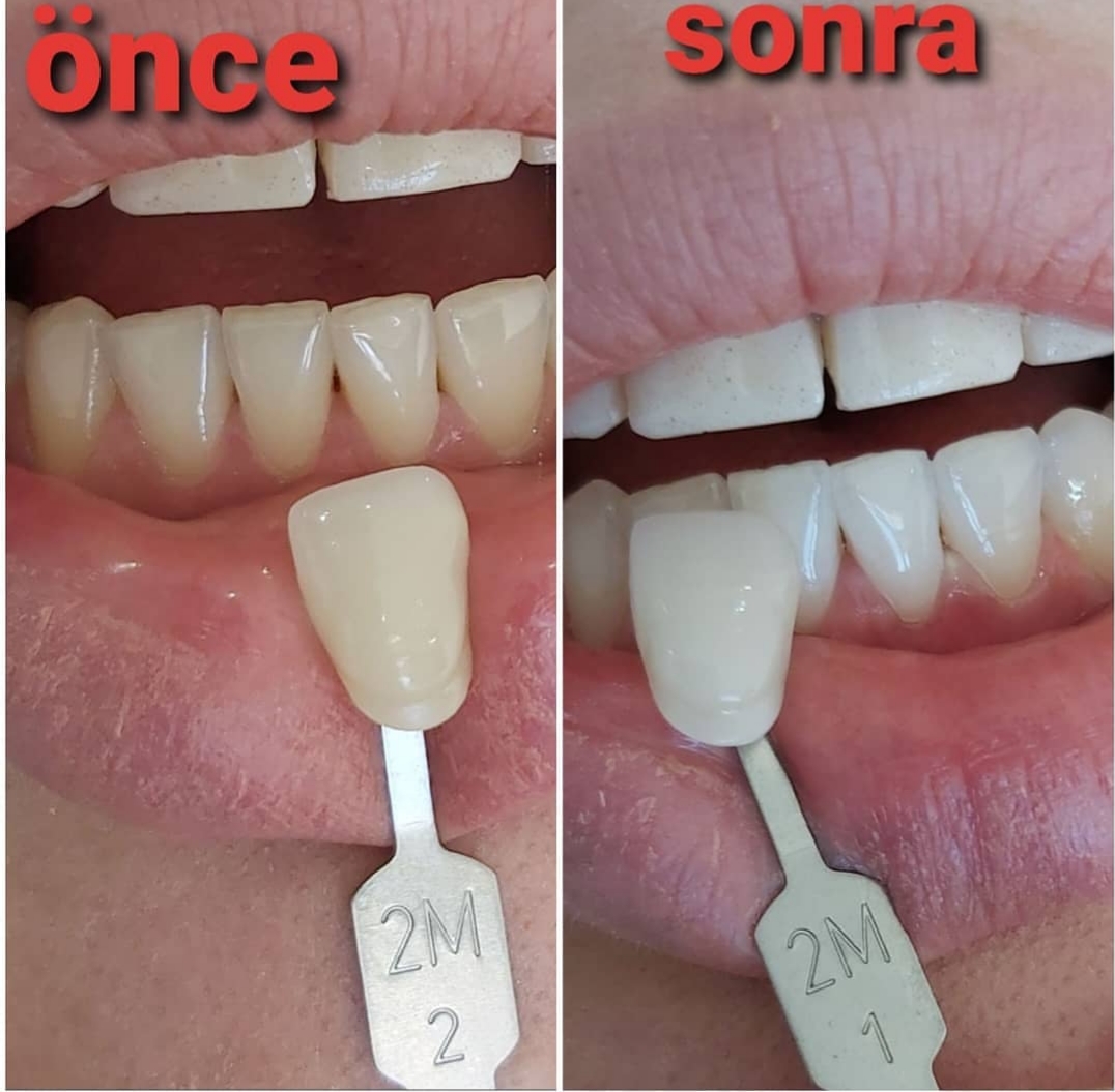 Profesyonel diş beyazlatma (bleaching) tedavisi önce ve sonra