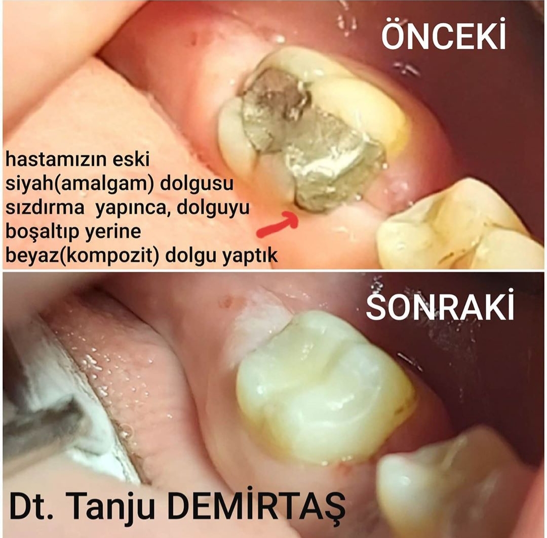Siyah amalgam dolgunun beyaz kompozit dolgu ile değiştirilmesi